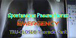 Pneumothorax